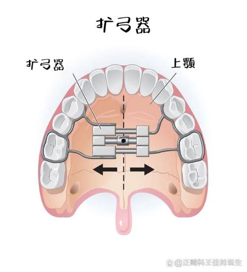 正畸扩弓的风险-图2