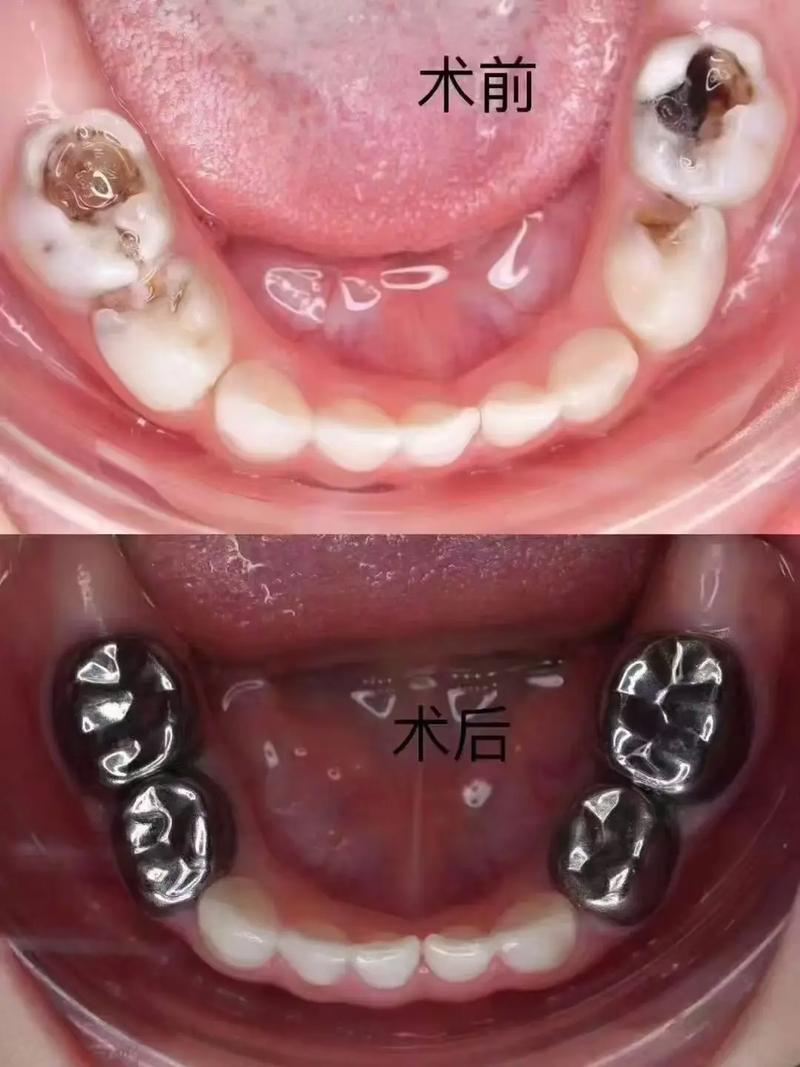 口腔正畸预成冠-图1