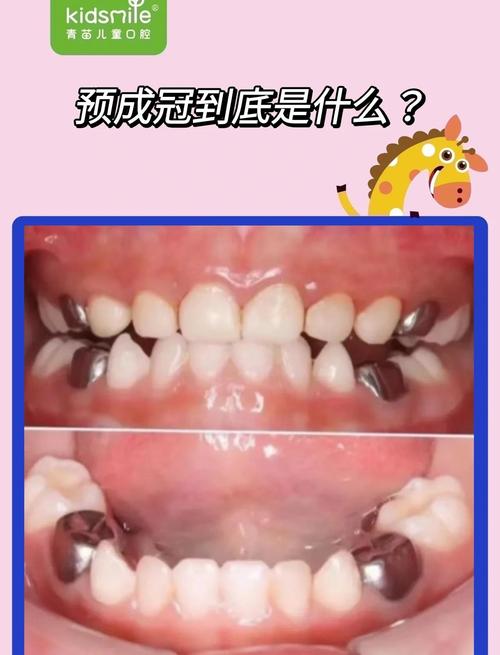 口腔正畸预成冠-图2