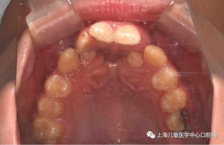 唇腭裂正颌正畸-图1