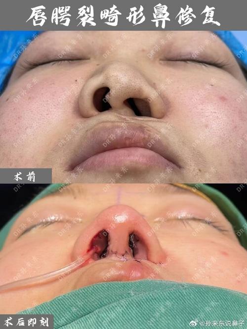 唇腭裂正颌正畸-图2