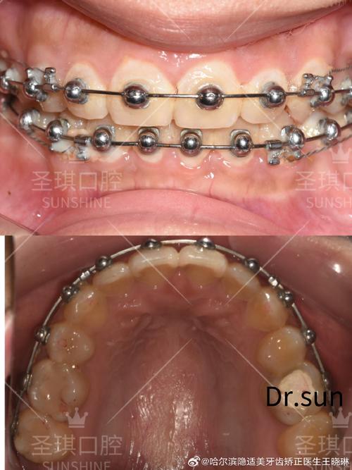 正畸完成牙槽骨-图2 正畸完成牙槽骨-图2