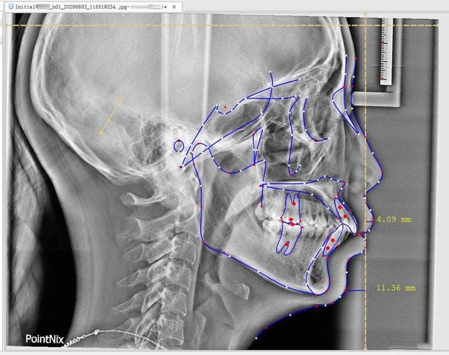 口腔正畸x光片-图2