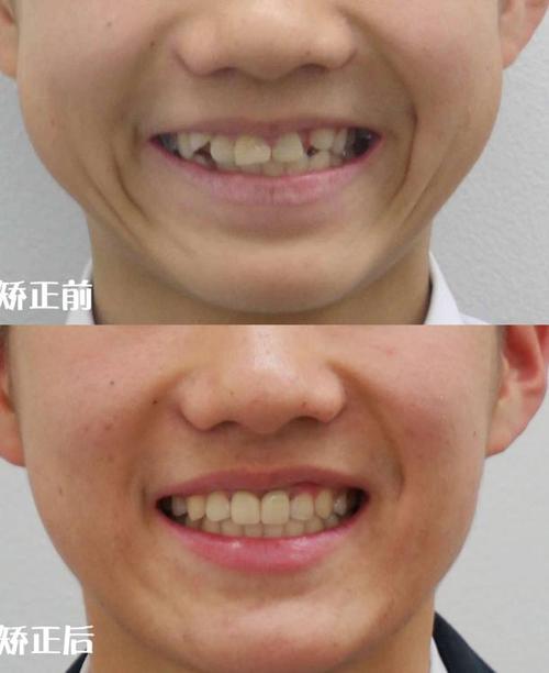 正畸3号牙后移-图1