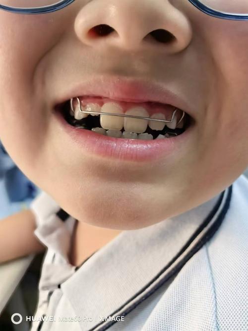 正畸矫正小孩子-图1