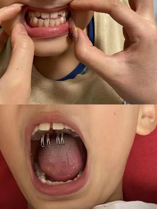 正畸矫正小孩子-图2