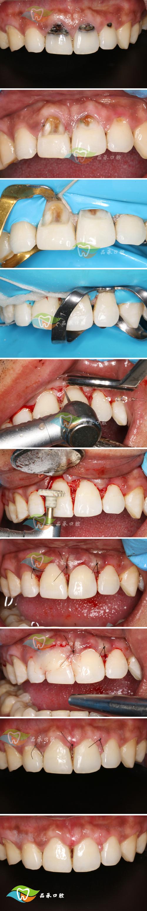 正畸牙掏根创伤-图3