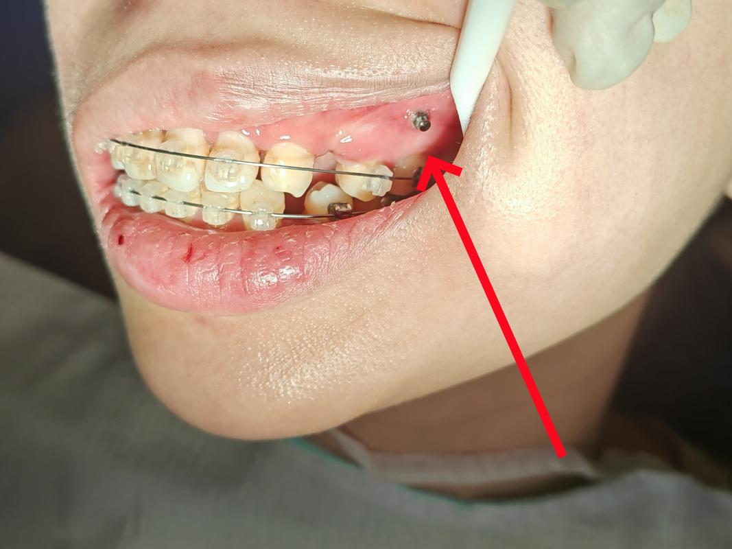 牙齿正畸拔骨钉-图1