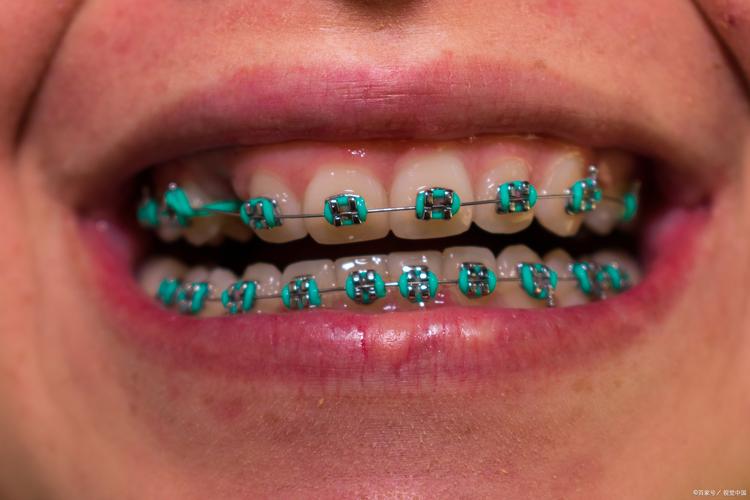 正畸收牙往里扣-图2