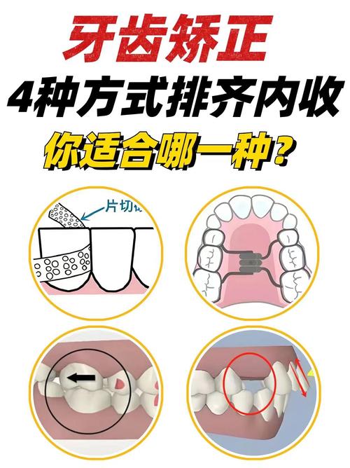 正畸收牙往里扣-图3