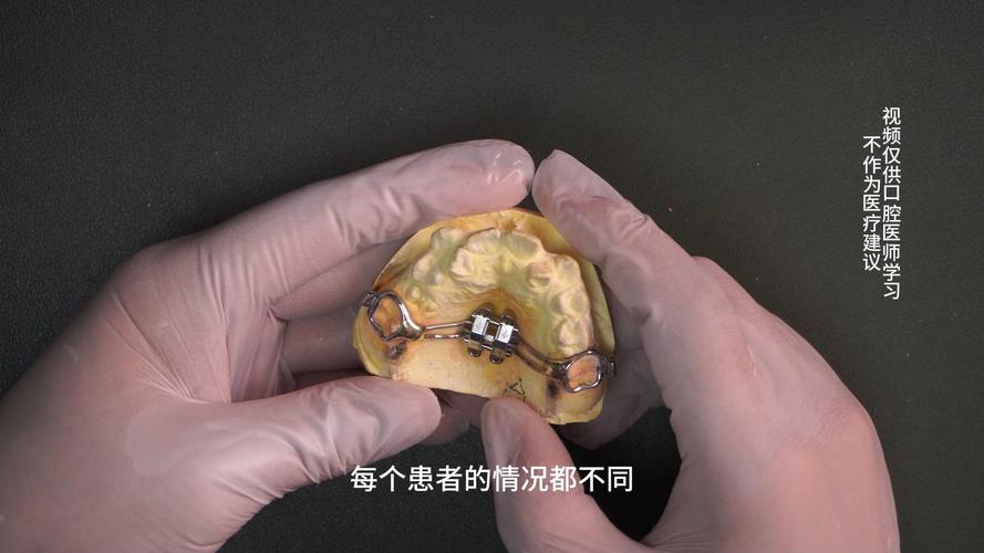 正畸卡瓦开口器-图2