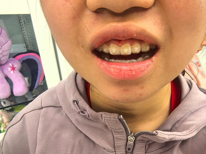 正畸后嘴巴歪了？矫正失败还是正常反应？-图2