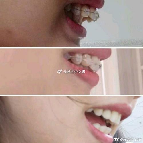 正畸后嘴巴歪了？矫正失败还是正常反应？-图3