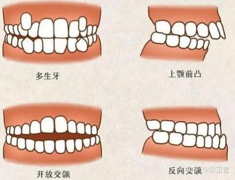 正畸费用高，没钱该如何是好？-图1