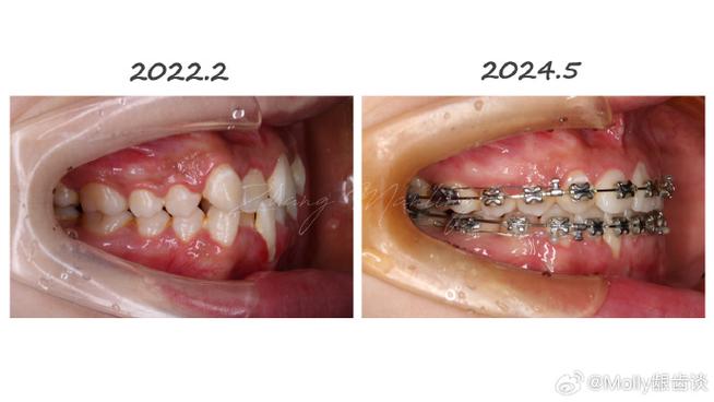 6颗牙正畸治疗-图1