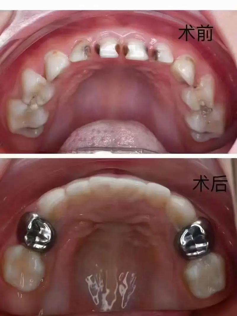 临时牙拆冠正畸-图3