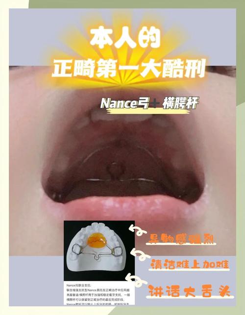 正畸腭弓的作用-图1 正畸腭弓的作用-图1