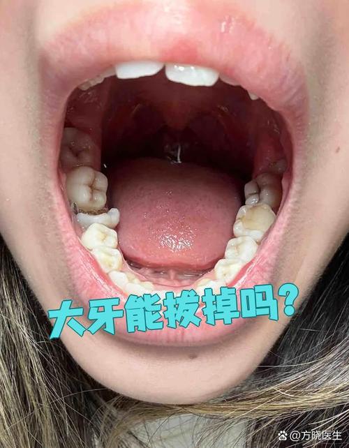 正畸拔3颗磨牙-图2