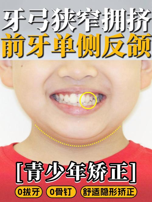 反颌正畸的危害-图1