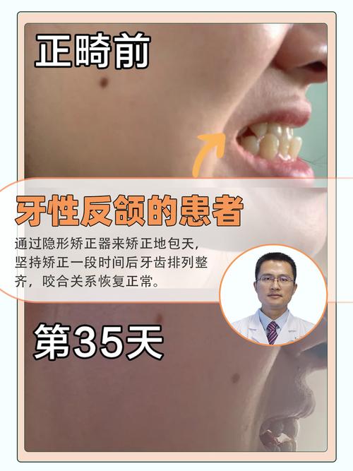 反颌正畸的危害-图2