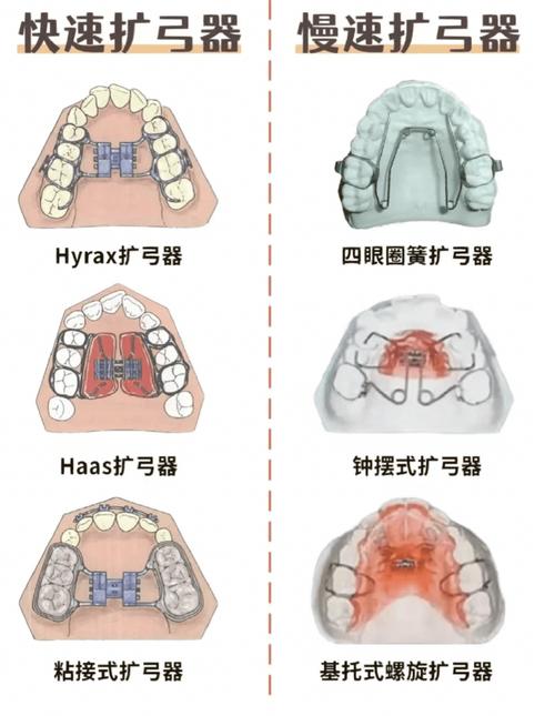 正畸扩弓骑士弓-图2