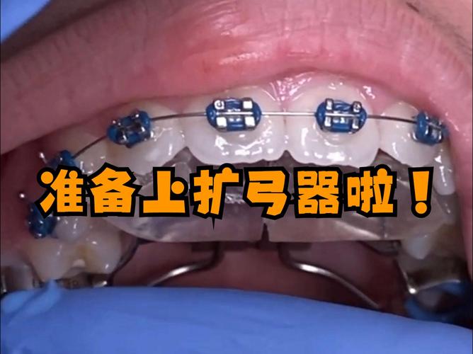 正畸扩弓骑士弓-图3