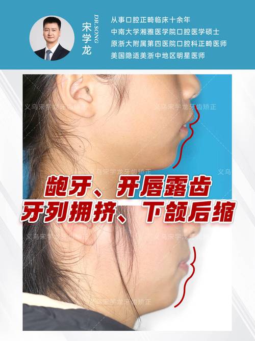 下颌平面角正畸-图3