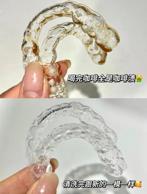 正畸带环摘下来-图2