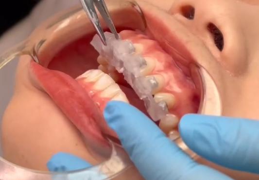 数字化正畸托槽-图1