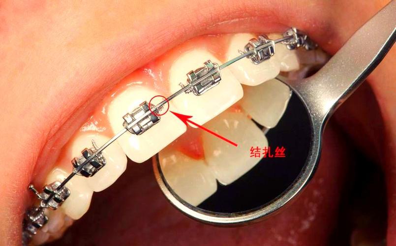 正畸矫正器照片-图1 正畸矫正器照片-图1
