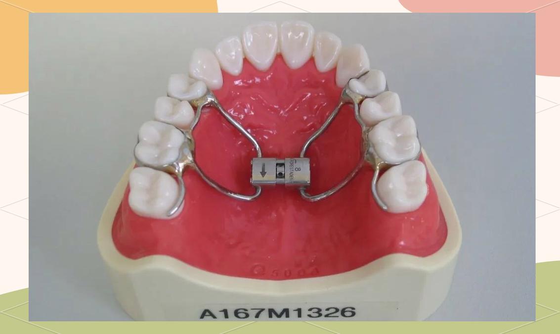 正畸新型扩弓器-图1