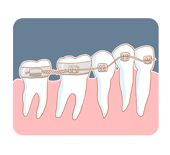 正畸过程动态图-图2 正畸过程动态图-图2
