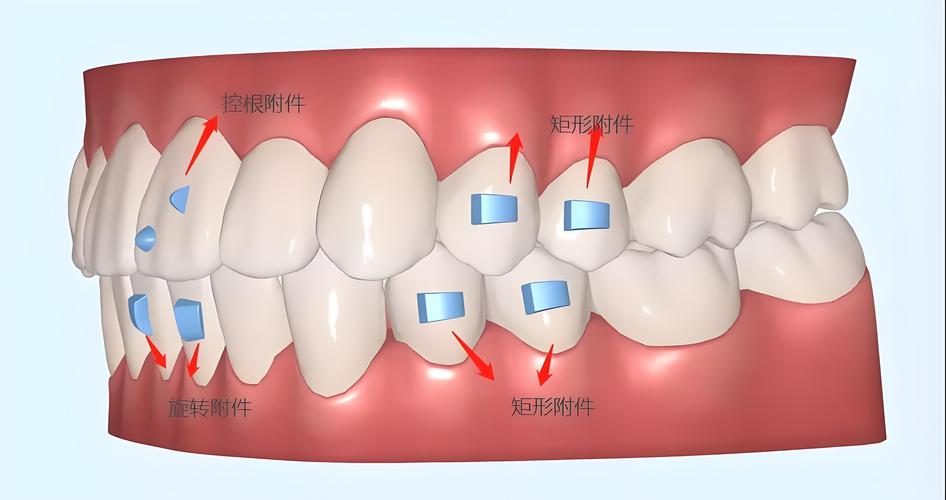正畸颊侧粘扣子-图1