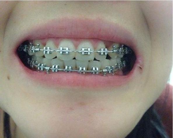 正畸端部钢丝刮伤口腔，原因何在？如何有效处理？-图3