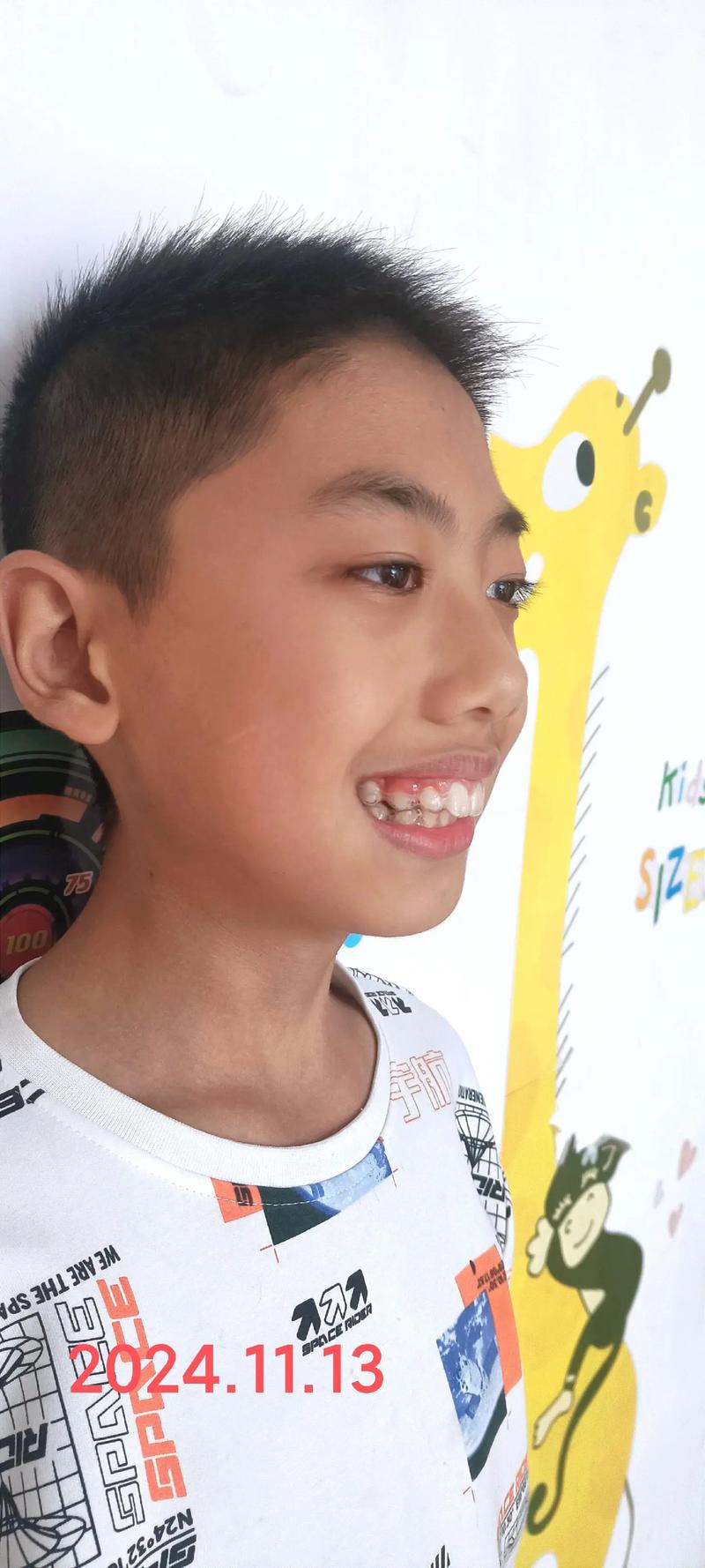 5月15日正畸，当天有哪些注意事项？-图1