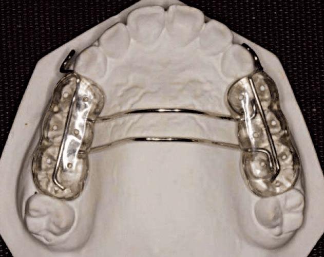 正畸口内阻挡臂-图2