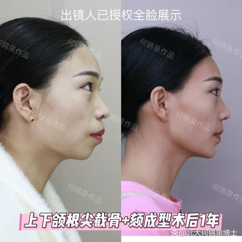 先颏成型后正畸-图1