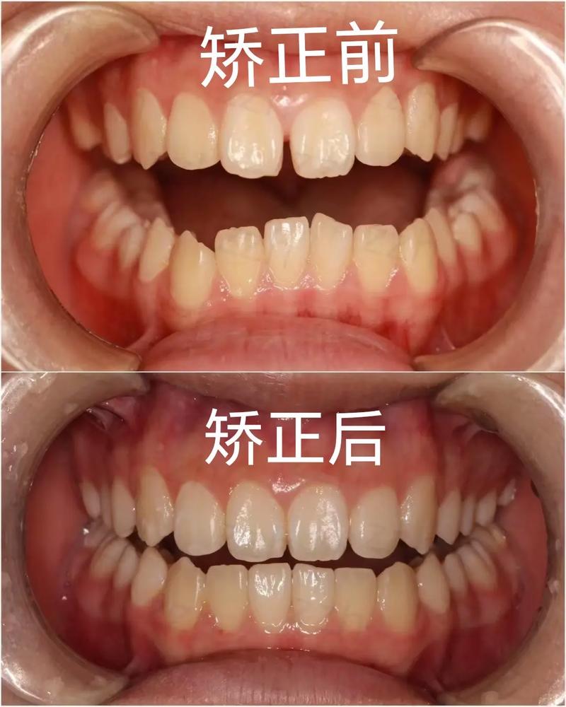 先颏成型后正畸-图2