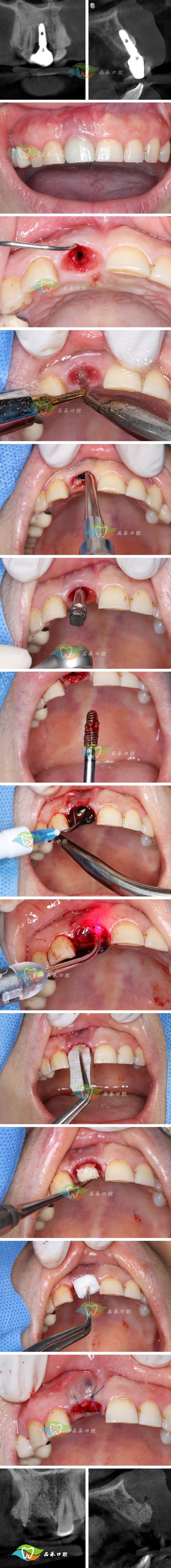 正畸唇刺的制作-图2 正畸唇刺的制作-图2