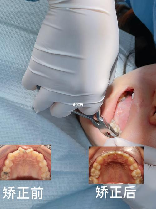 扭转牙正畸治疗-图2