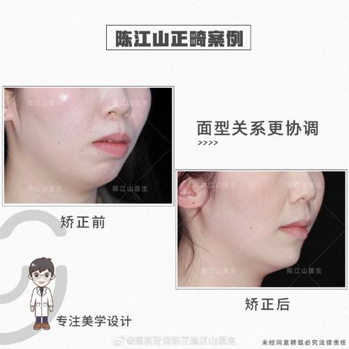 口腔正畸PM线-图2