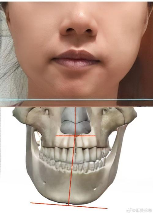正畸颌平面倾斜，成因是什么？如何制定有效矫正方案？-图1