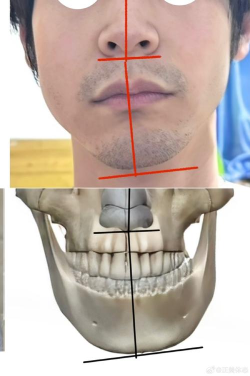 正畸颌平面倾斜，成因是什么？如何制定有效矫正方案？-图2