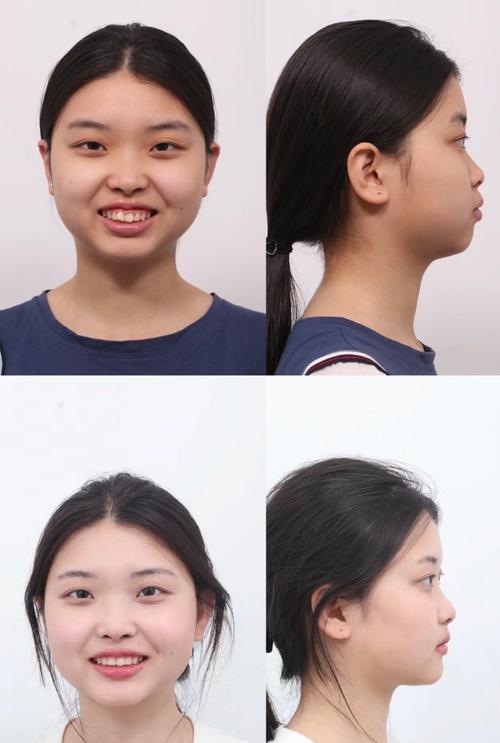 正畸摄影是什么？为何牙齿矫正前必须拍摄？-图1