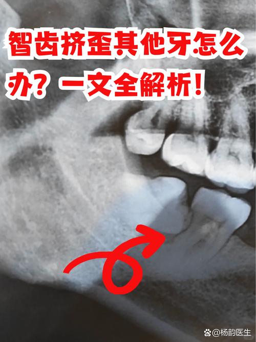 正畸不敢拔智齿-图2