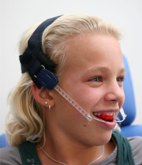 正畸导板图片能看出牙齿矫正的关键效果吗？-图2