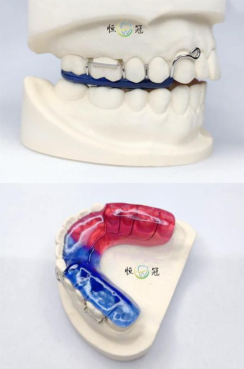 正畸导板图片能看出牙齿矫正的关键效果吗？-图1
