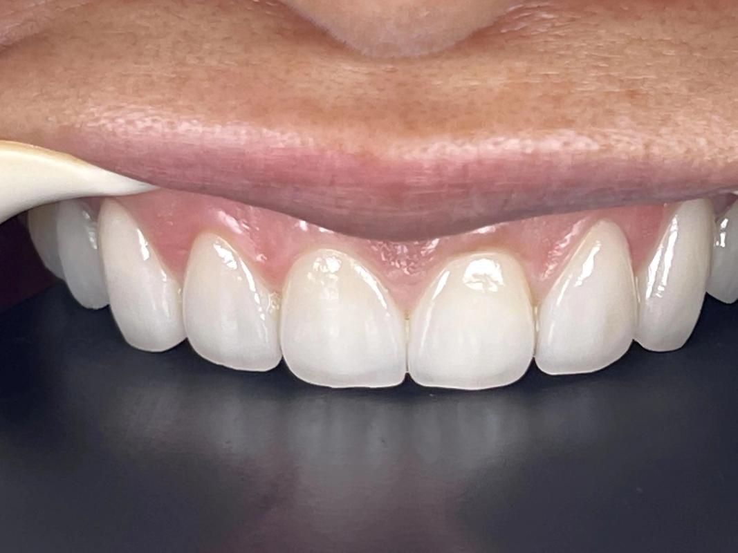 瓷贴面能做正畸-图1