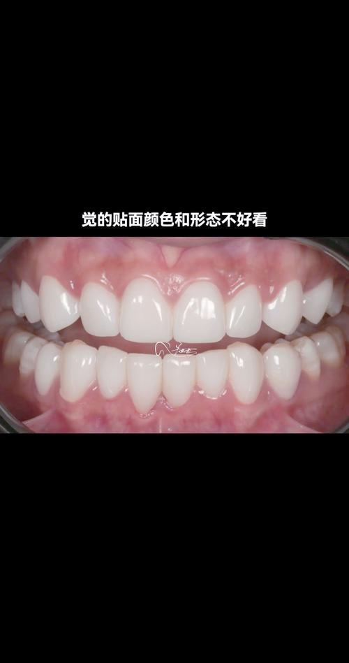 瓷贴面能做正畸-图2