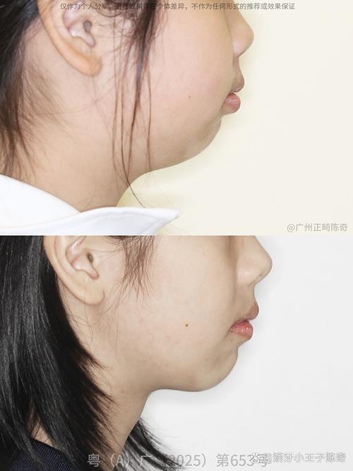 下巴短口腔正畸-图1